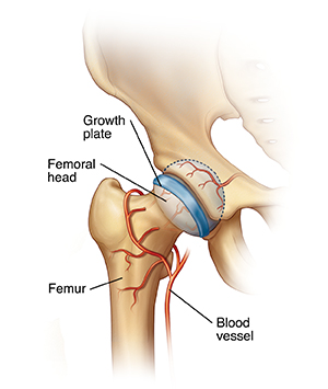 Closeup front view of hip joint showing femur and femoral head fitting into socket in pelvis. Blood vessels wrap around femur and go to femoral head. Growth plate is across femoral head.