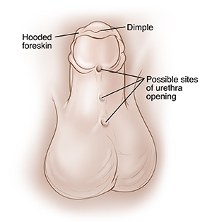 Child's penis with penis pointing up to show underside. Foreskin surrounding glans is hooded and drapes over tip of penis. Dimple in tip of penis. Three holes along underside of penis in center from glans to scrotum show possible sites of urethra opening.