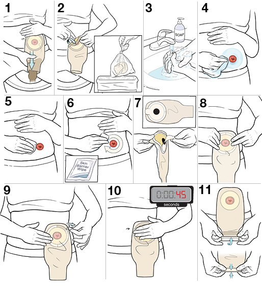 11 steps for changing your stoma's pouch