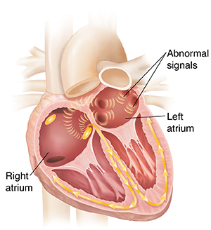 Cross section of heart showing atrial fibrillation.