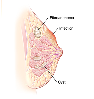 Cross section side view of breast showing nipple, glands, fat, and chest muscle.