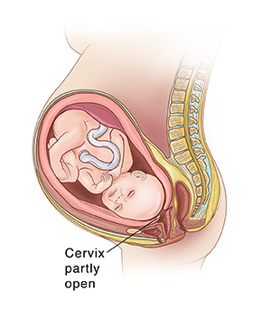 Side view of fetus in uterus showing cervix beginning to thin and open during active labor.