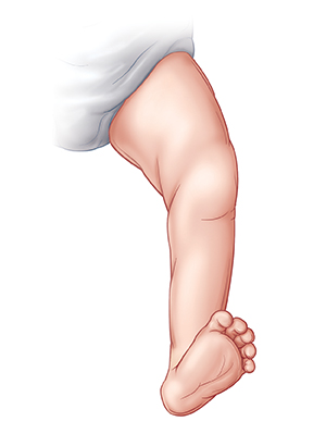 Outline of baby's leg showing foot pointing upward and outward (calcaneovalgus).