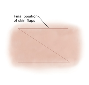 Z-plasty skin incision after skin flaps moved into place.