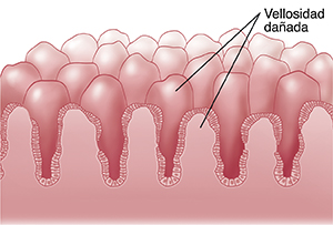 Primer plano de un corte transversal de las vellosidades del intestino dañadas.